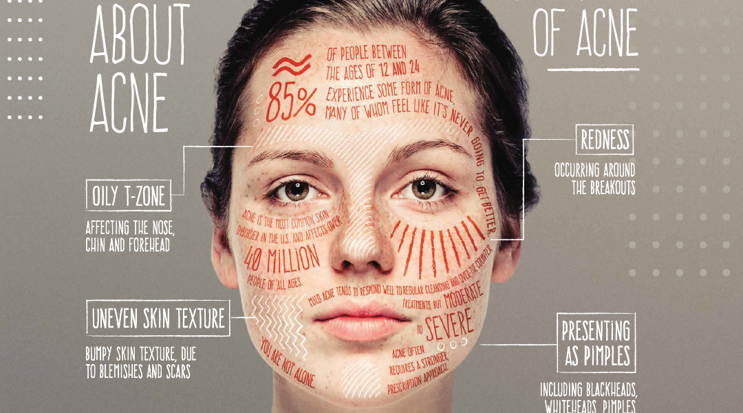 Acne Attack: Your Battle Plan